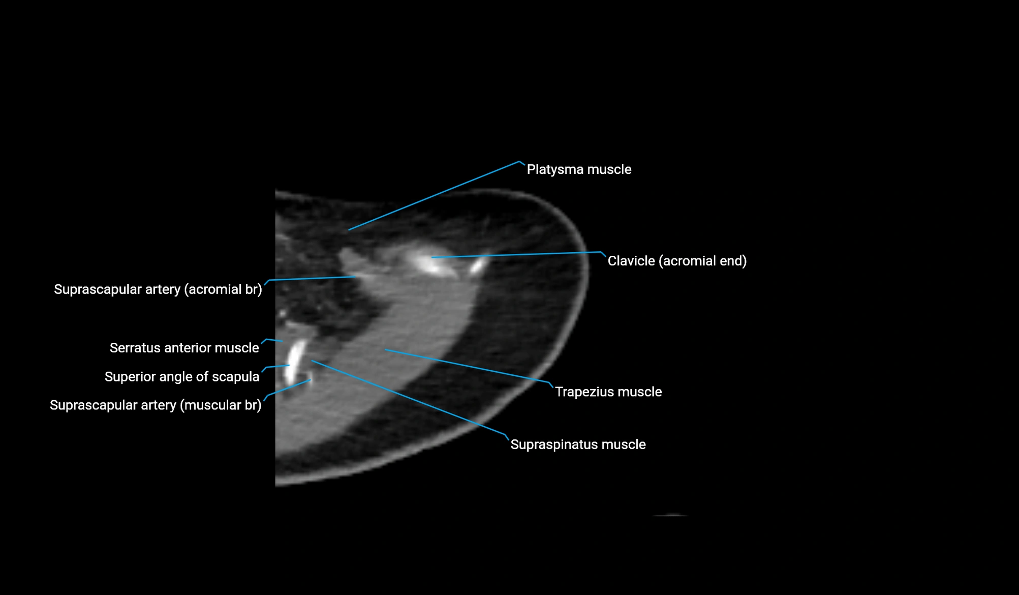 CT upper arm axial  cross sectional anatomy labelled radiology image -00052.webp